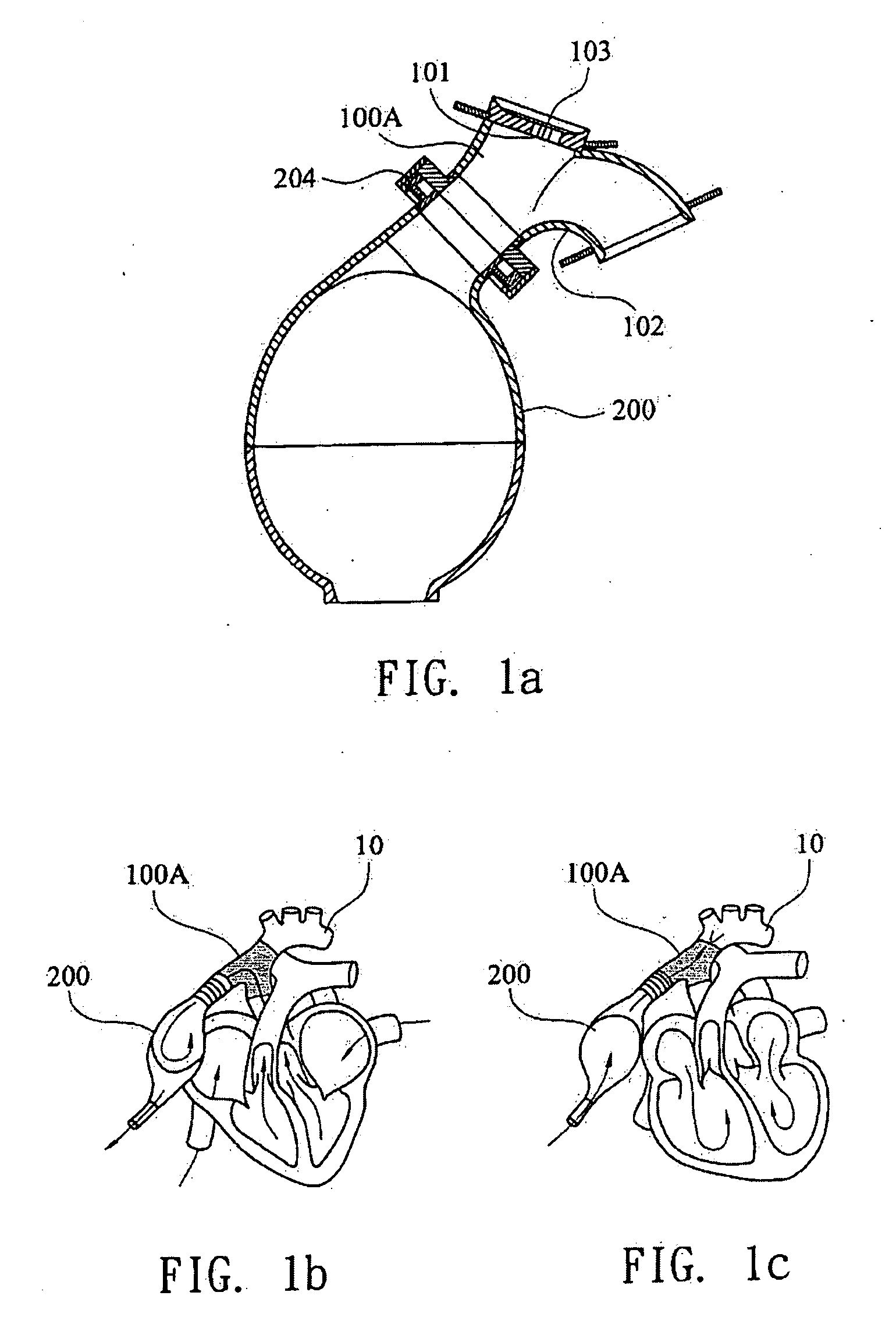 Ventricular Assist Device