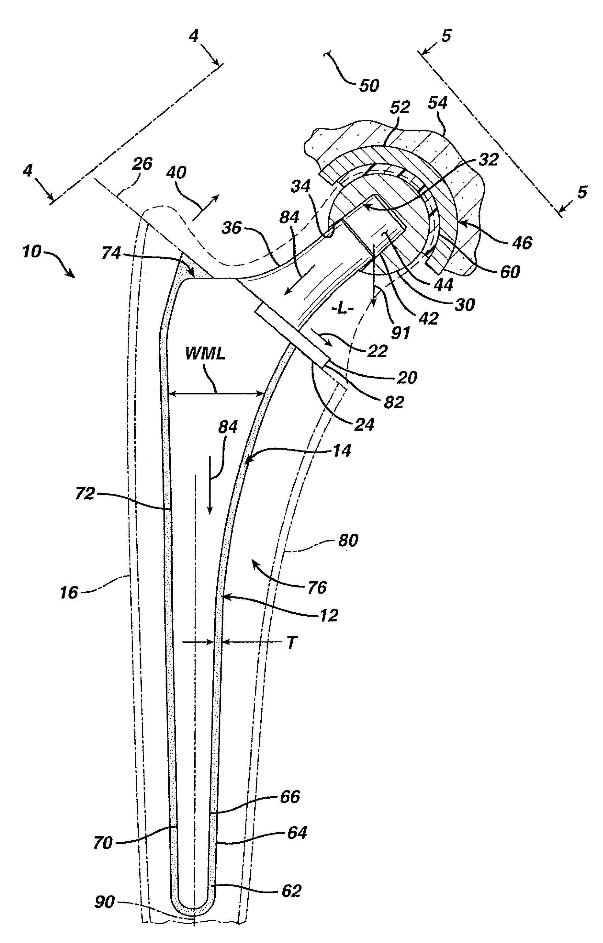 Prosthesis with resorbable collar