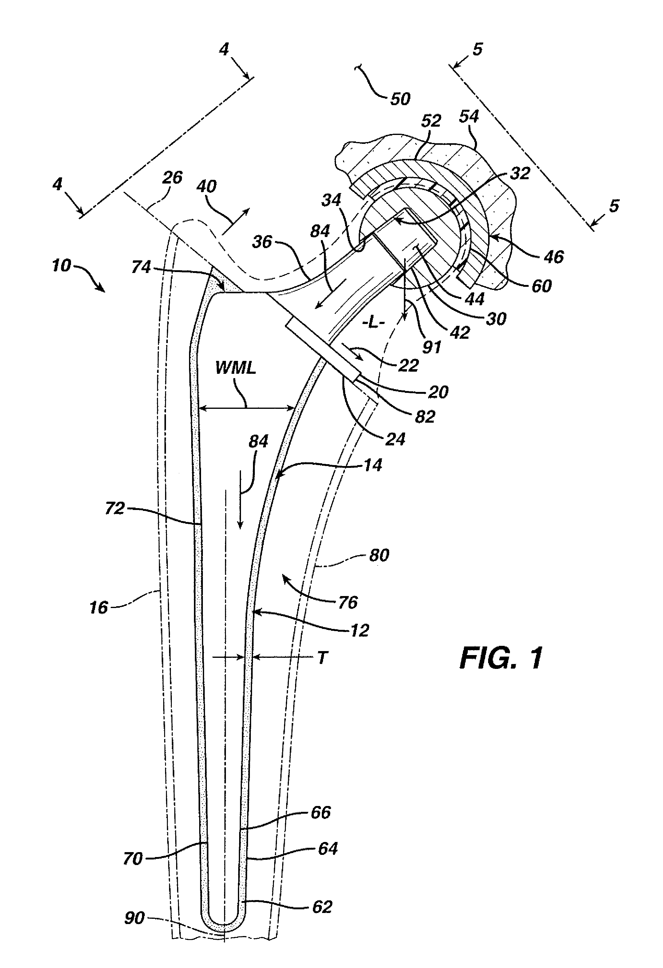 Prosthesis with resorbable collar