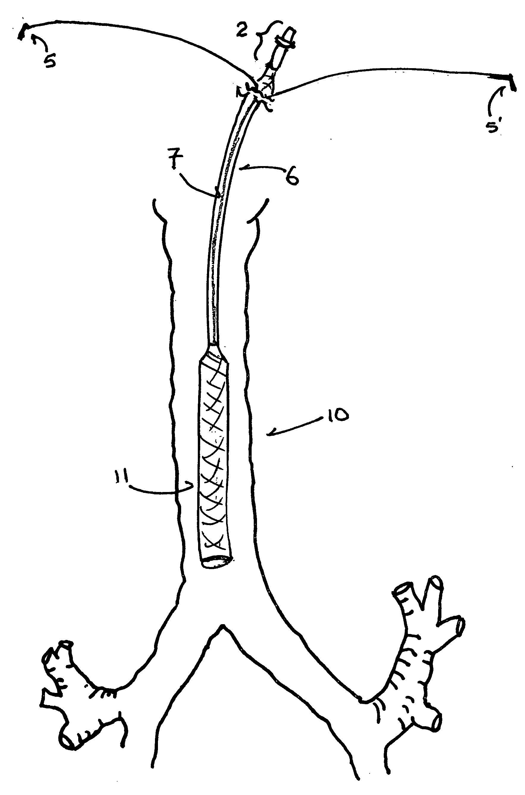 Shape-memory port-access tube