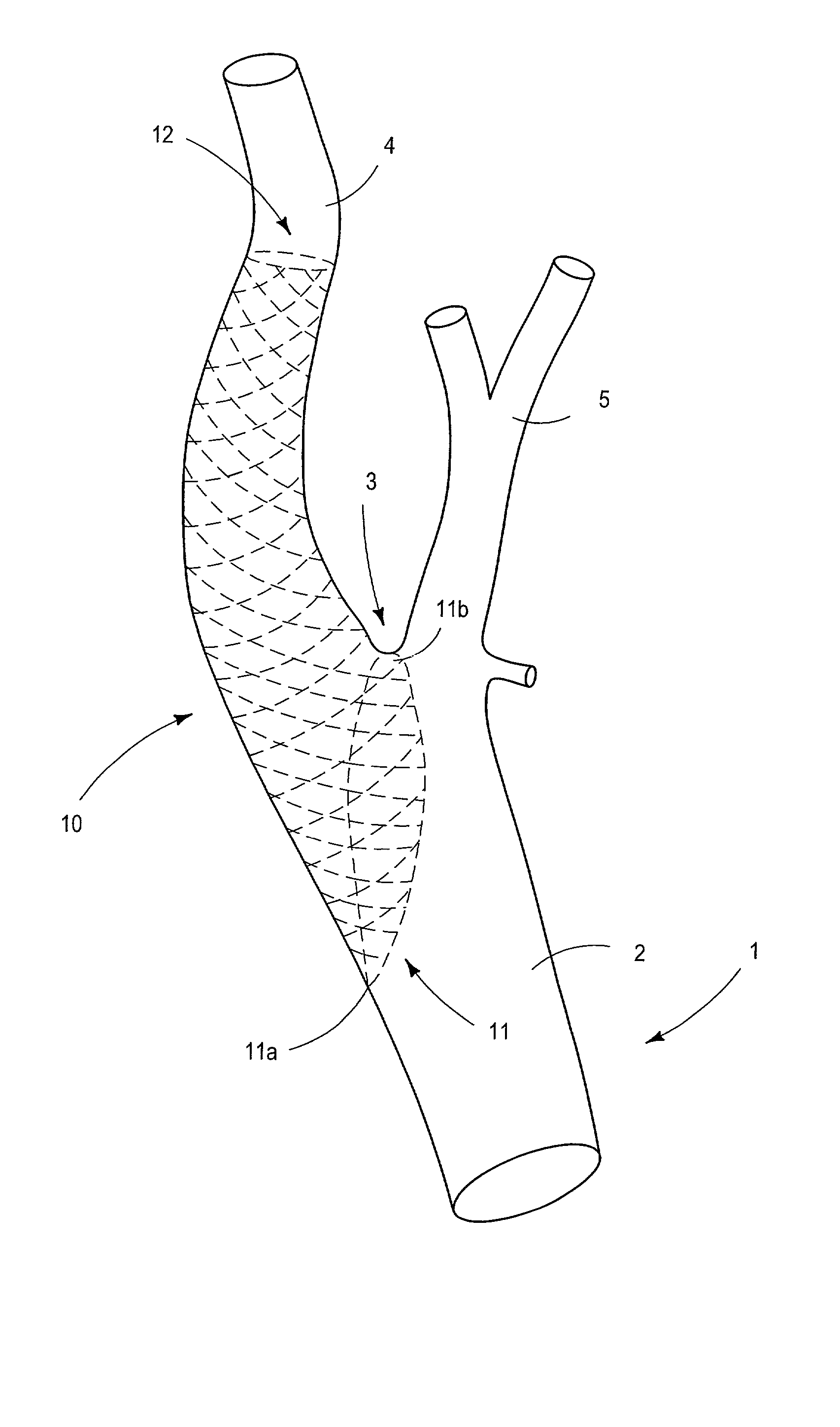 Virtual stent making process based upon novel enhanced plate tectonics derived from endoluminal mapping