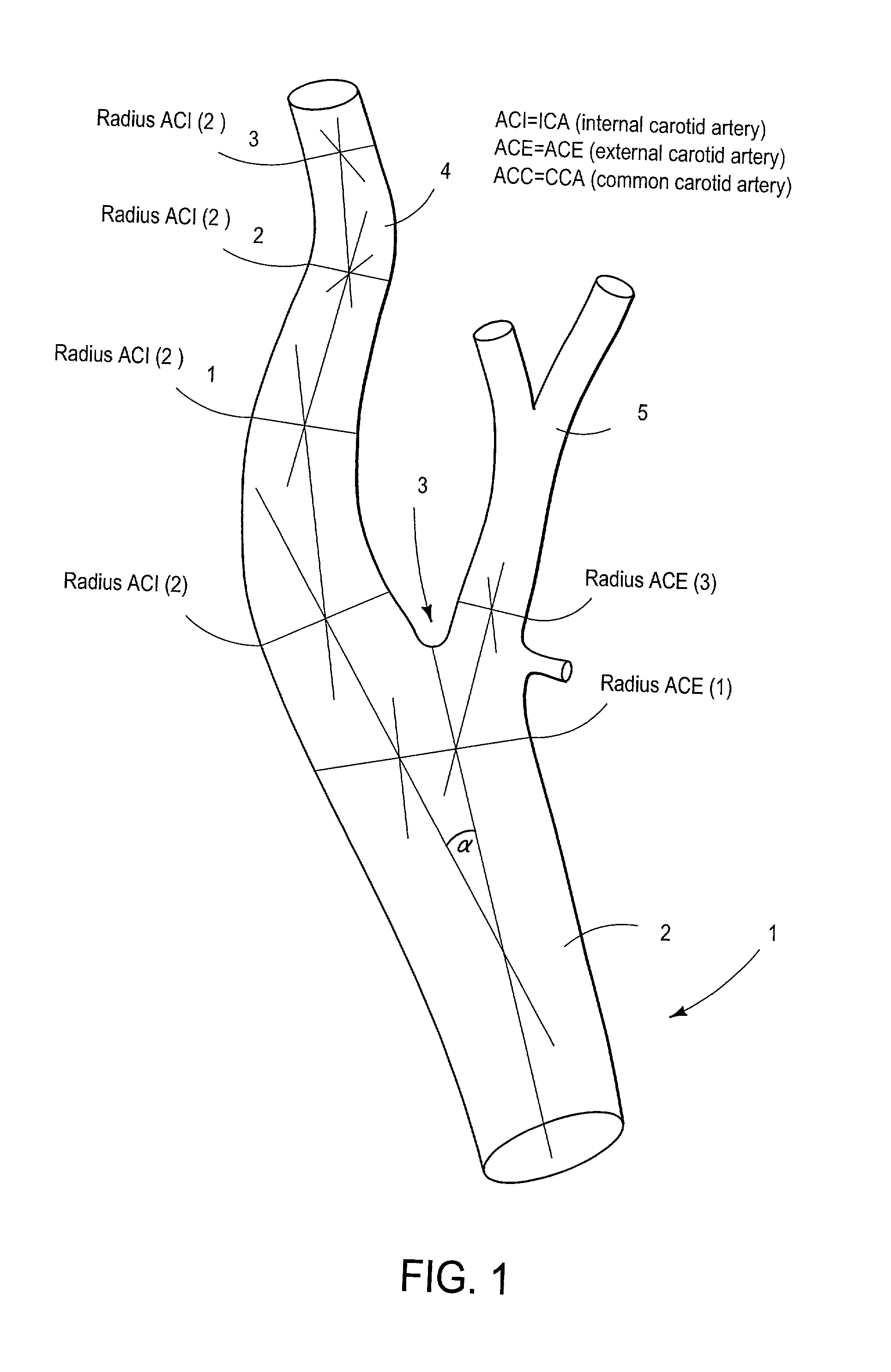 Virtual stent making process based upon novel enhanced plate tectonics derived from endoluminal mapping