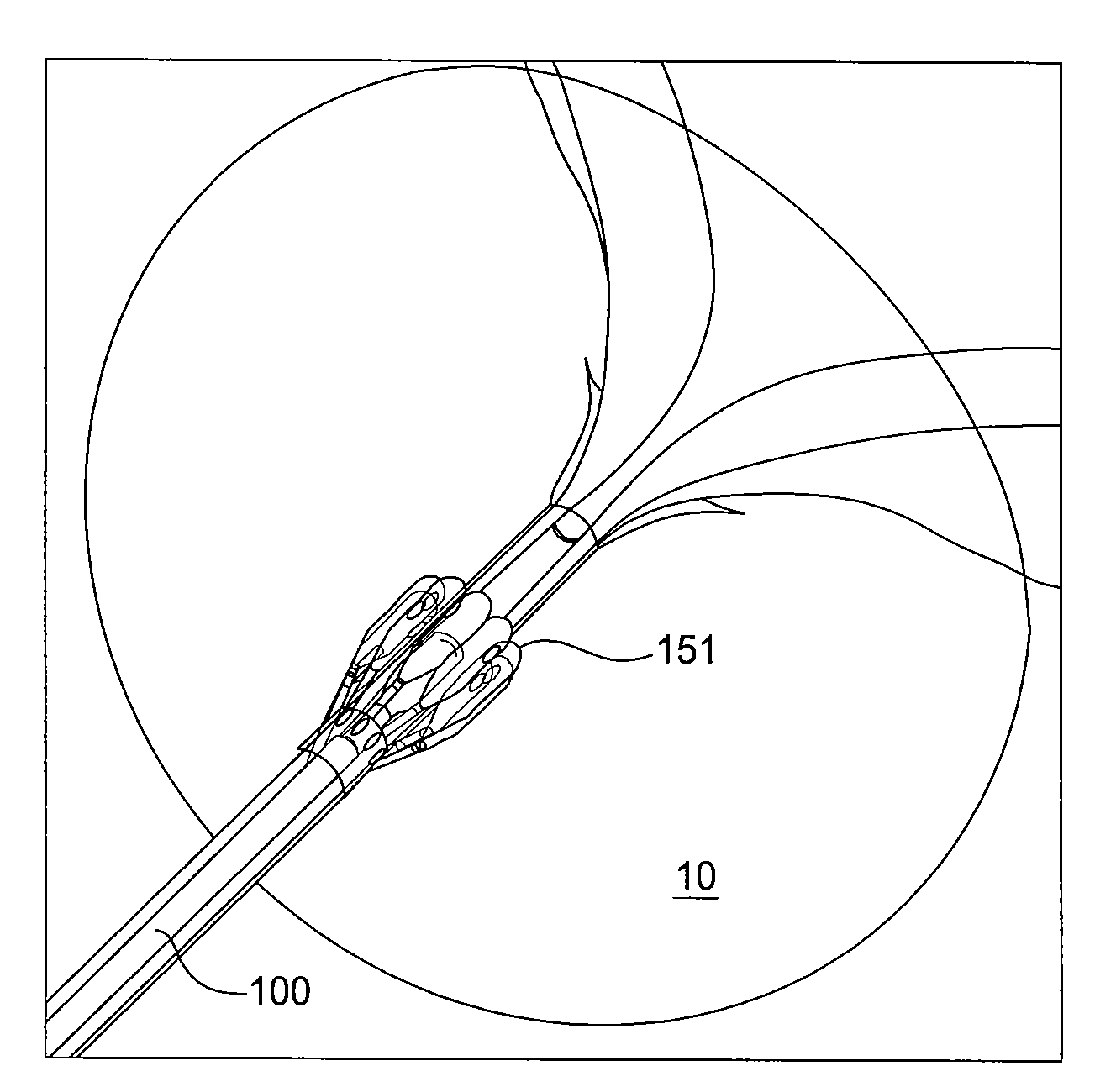 Apparatus and method for prostatic tissue removal