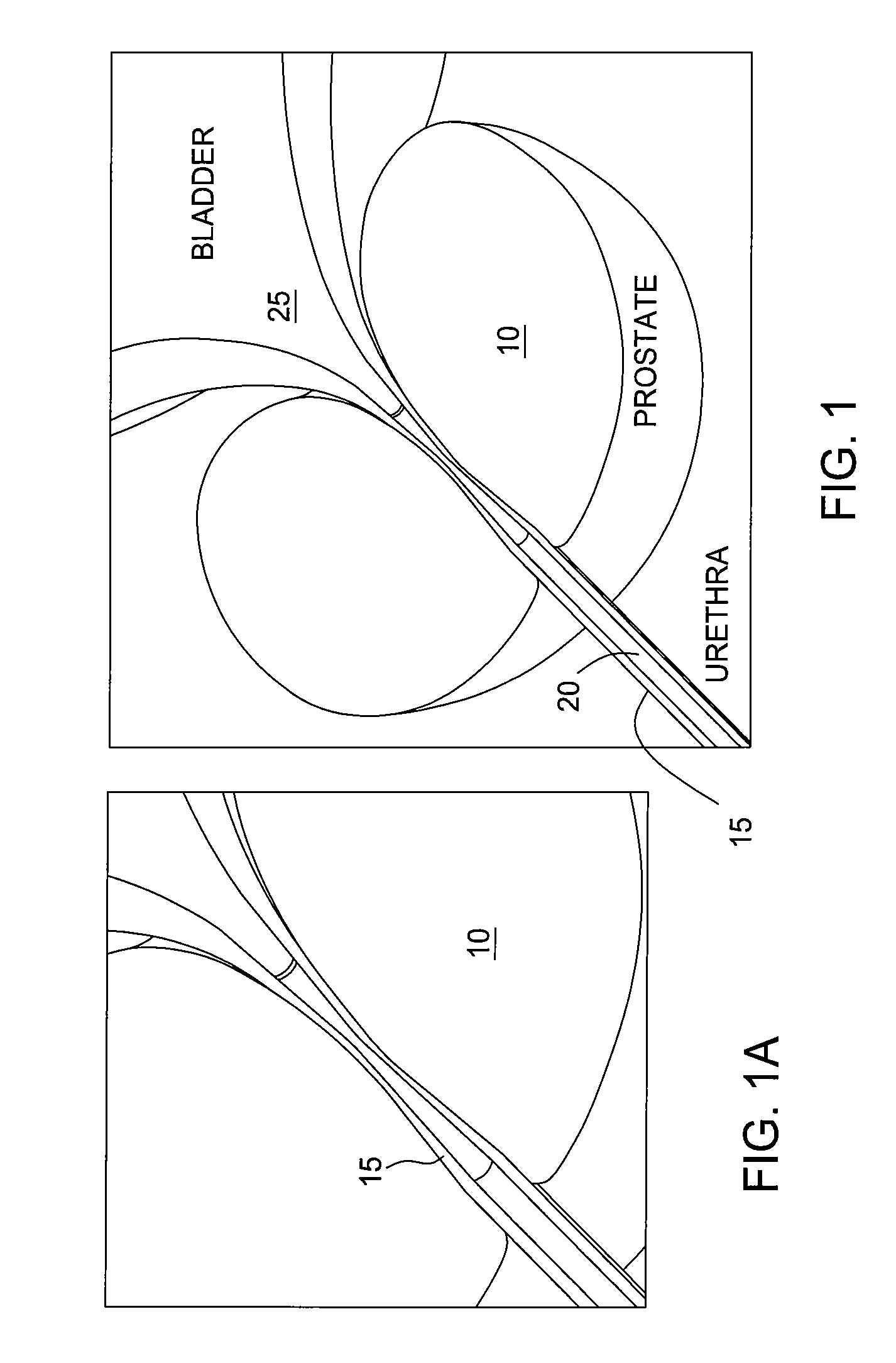 Apparatus and method for prostatic tissue removal