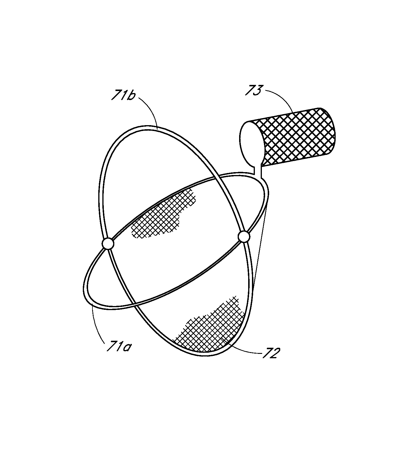 Percutaneous method and device to treat dissections