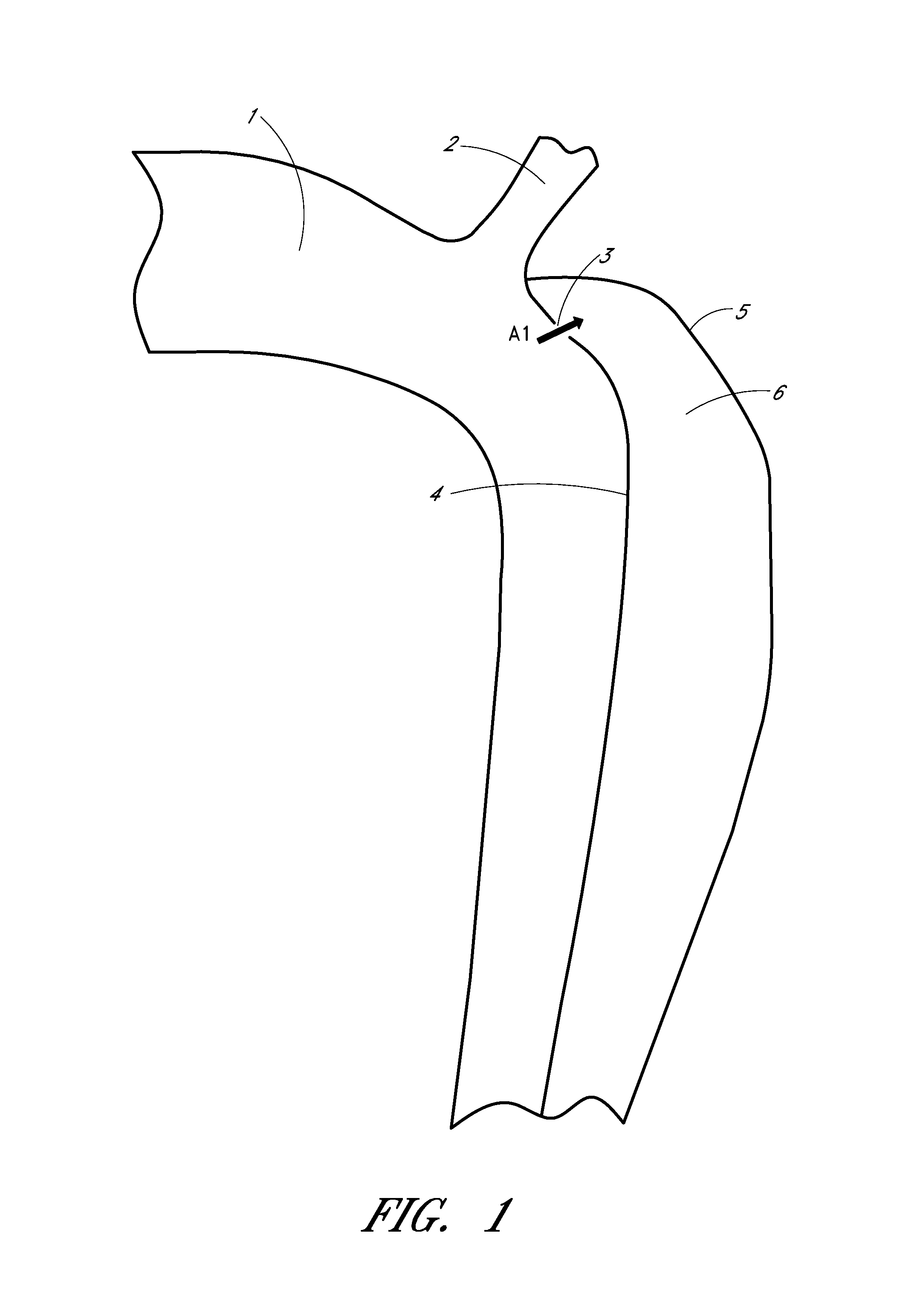 Percutaneous method and device to treat dissections