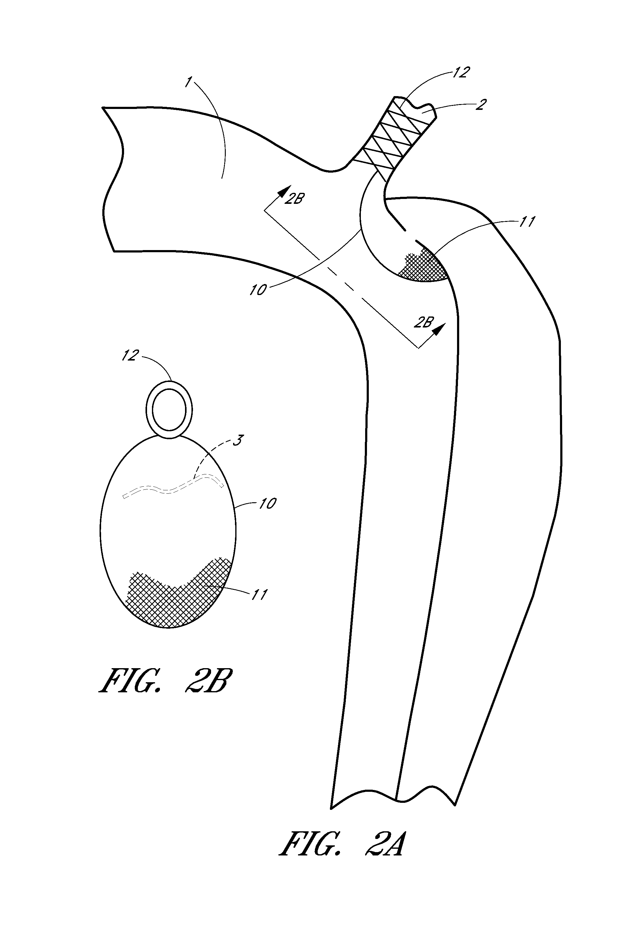 Percutaneous method and device to treat dissections