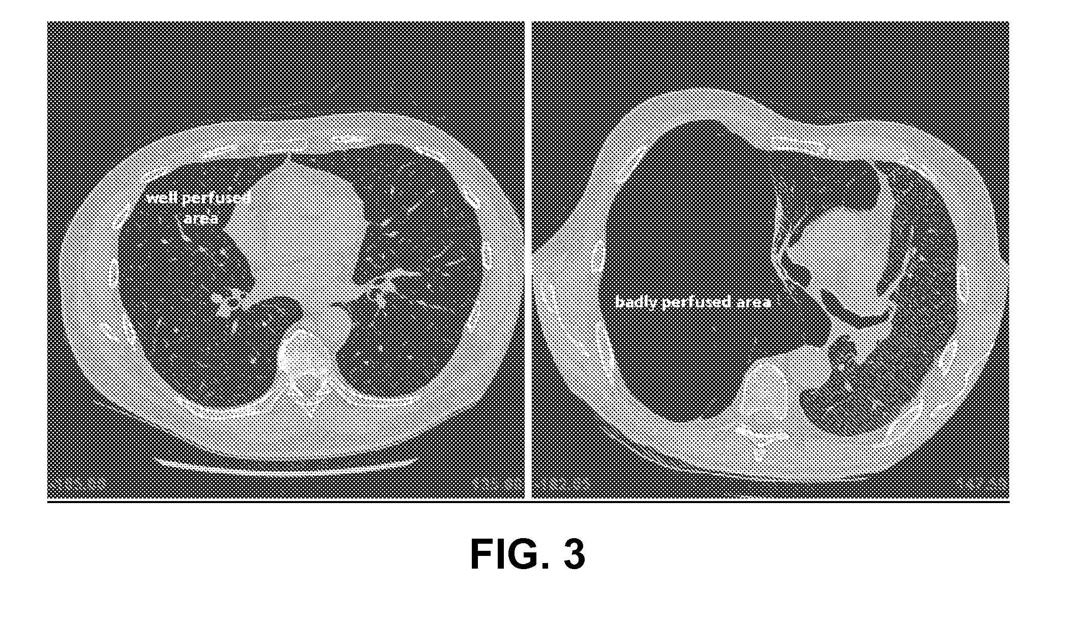 Method for determining treatments using patient-specific lung models and computer methods