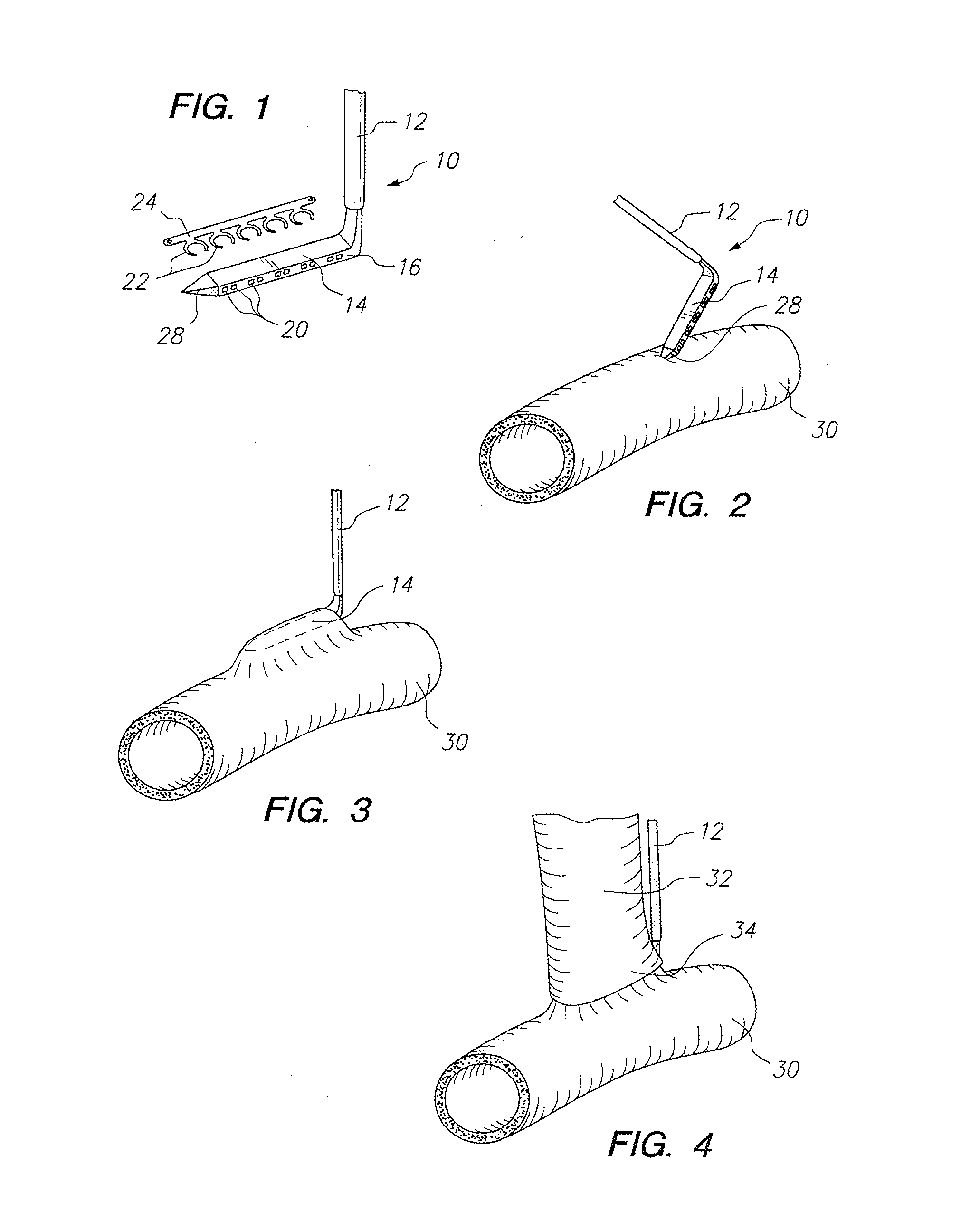 Anastomosis System with Anvil Entry Hole Sealer