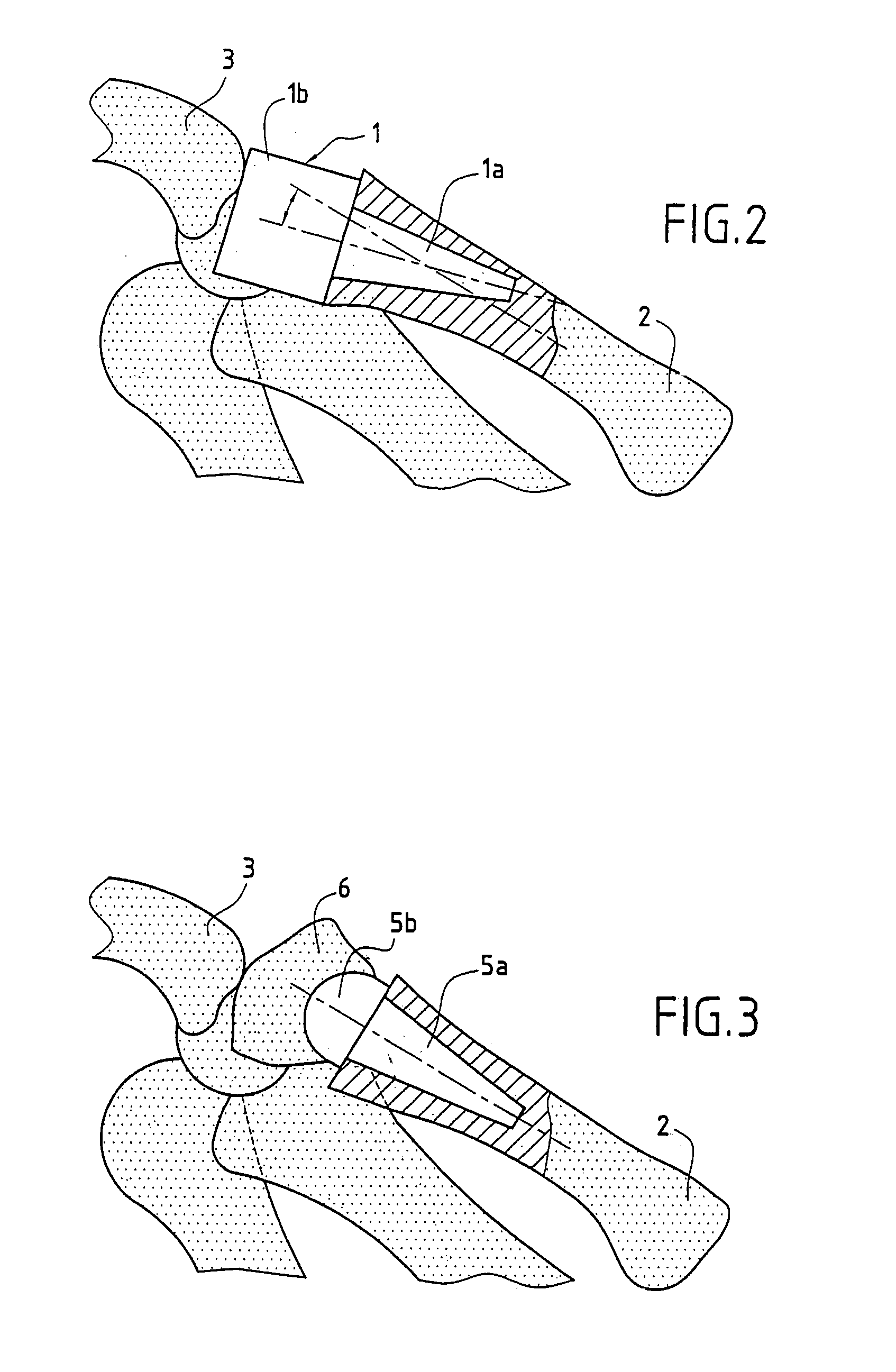 Trapezium or trapezometacarpal implant