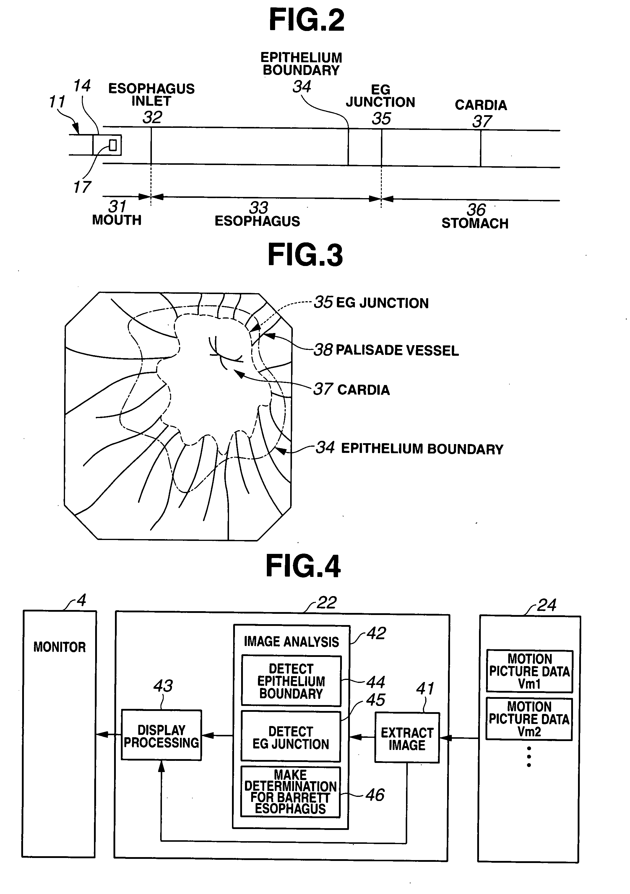 Medical Image Processing Apparatus, Luminal Image Processing Apparatus, Luminal Image Processing Method, and Programs for the Same