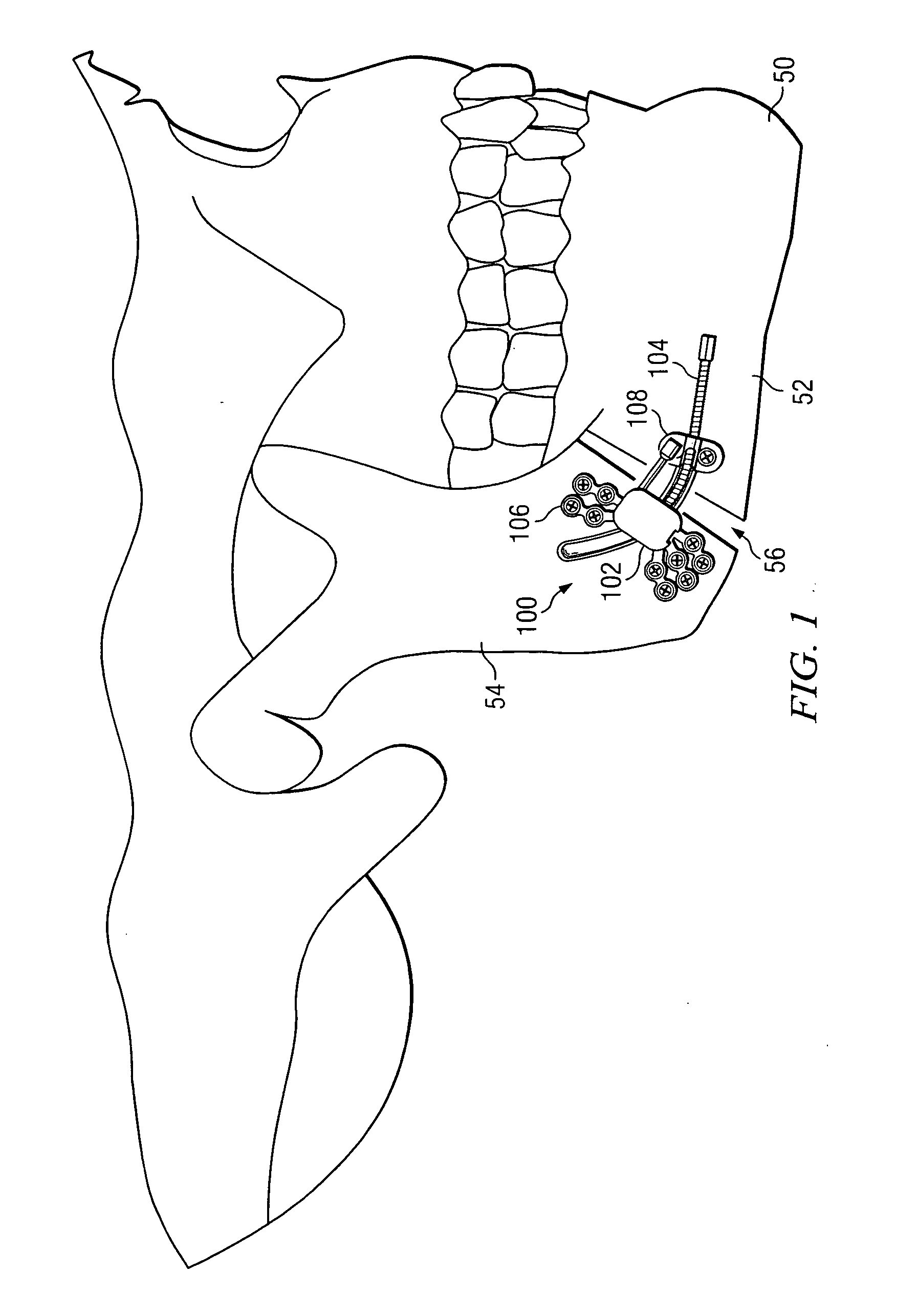 Curve linear and straight mandibular distractor with occlusion correction feature