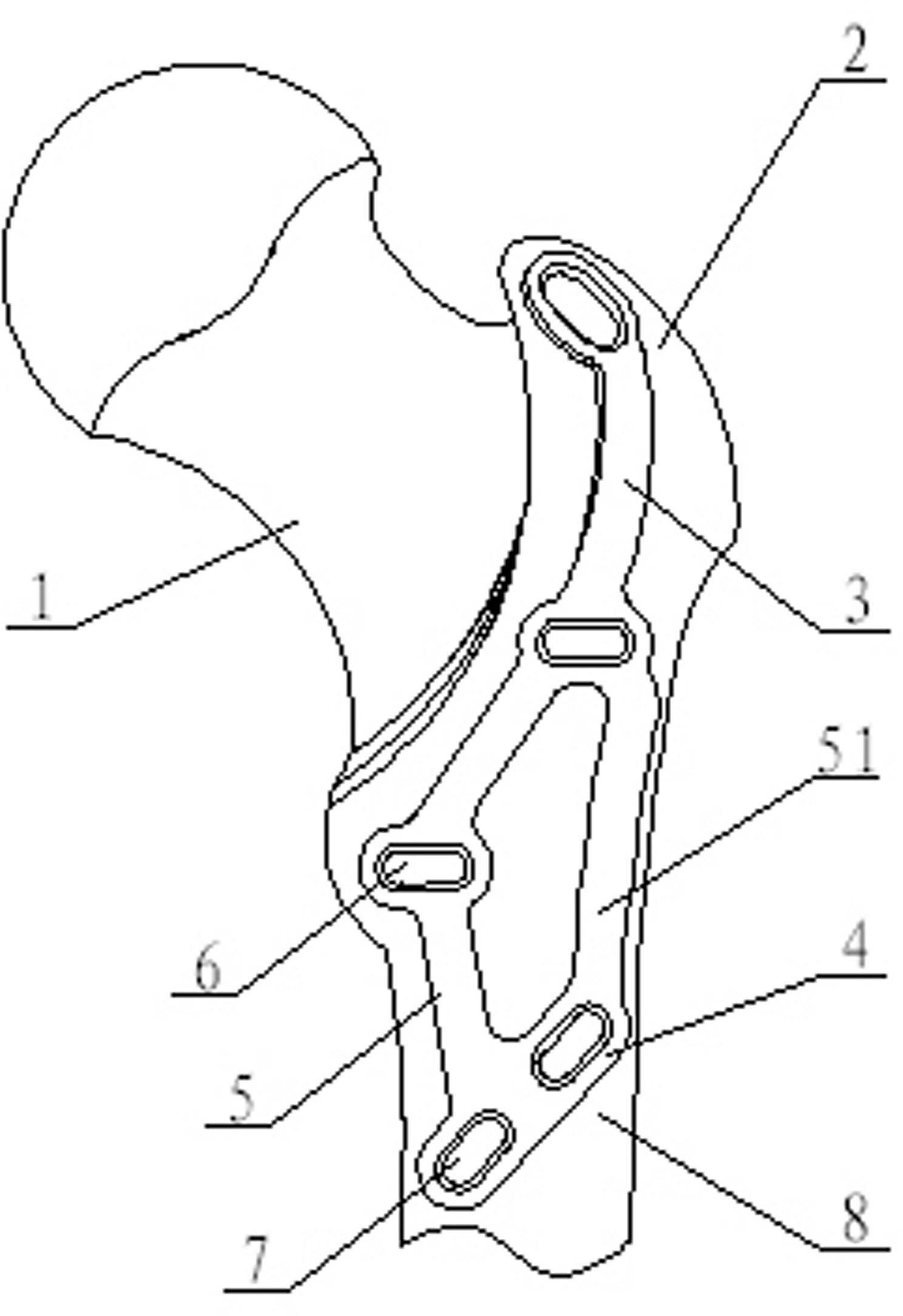 Minimally invasive tuberositas comminuted fracture back side pressurizing type fixation bone fracture plate