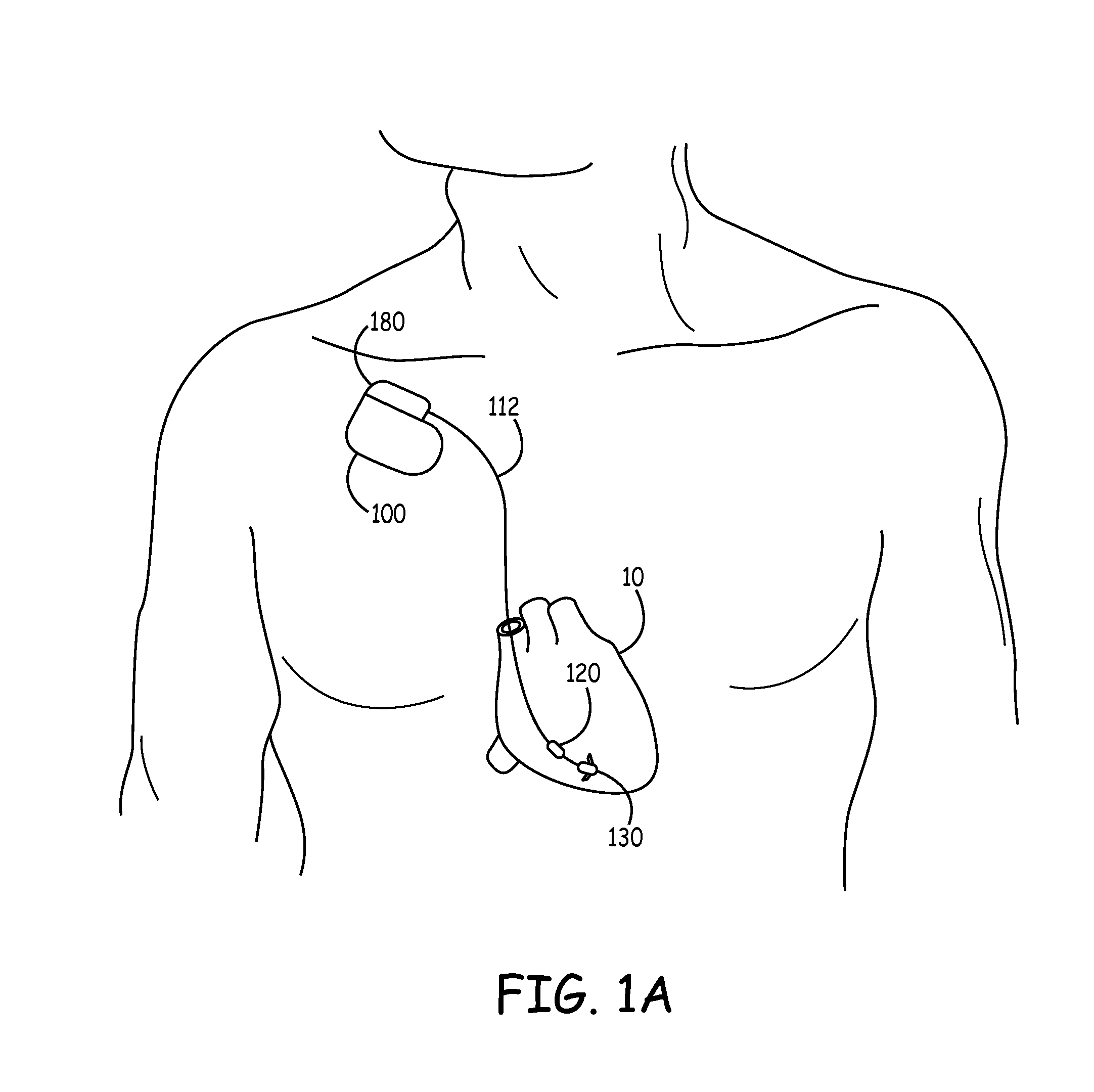 Heart failure monitor quicklook summary for patient management systems