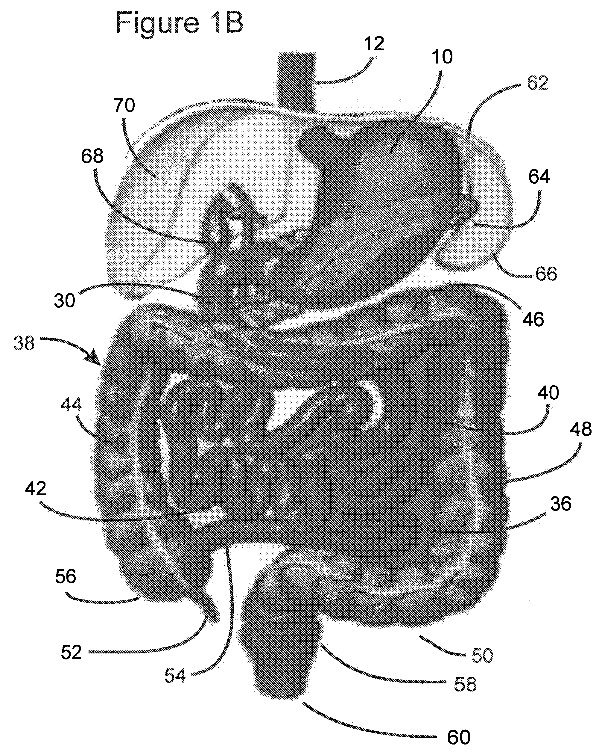 Process for electrostimulation treatment of morbid obesity