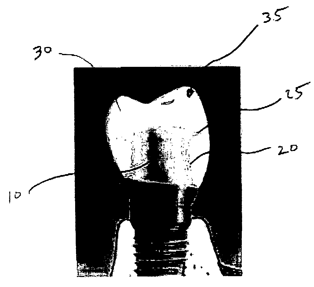 High strength substructure reinforcement for crowns and bridges