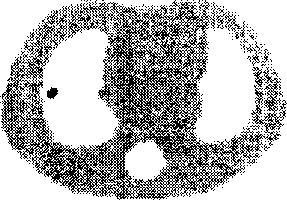 Interation curative wave filtration combined weighted least squares positron emission tomography method