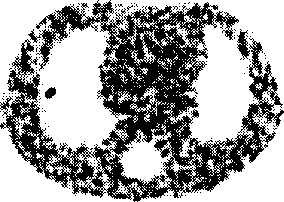 Interation curative wave filtration combined weighted least squares positron emission tomography method