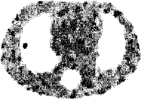 Interation curative wave filtration combined weighted least squares positron emission tomography method