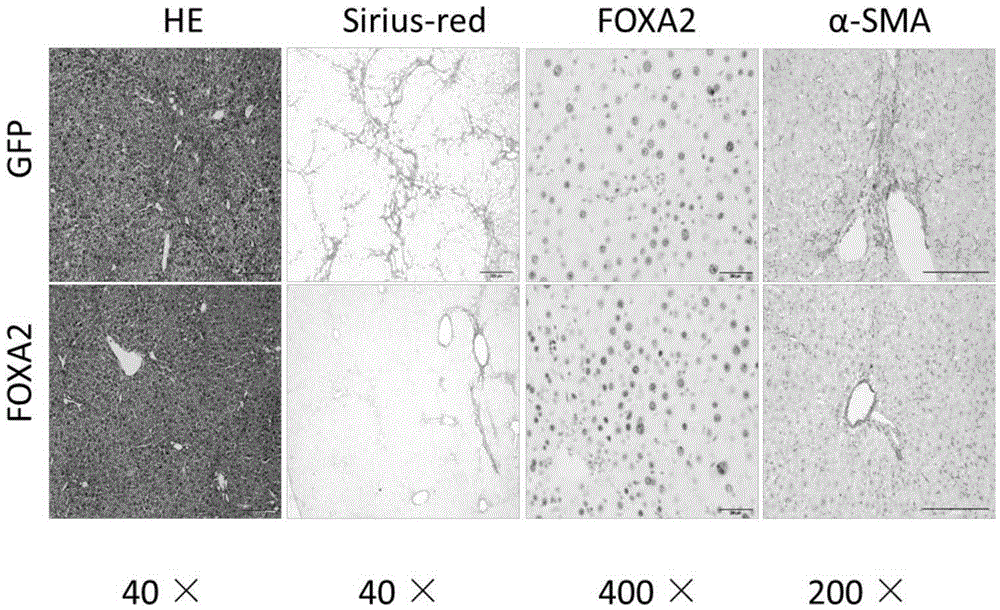 Application of box Forkhead box (FOXA2) in preparation of medicine for treating chronic liver disease