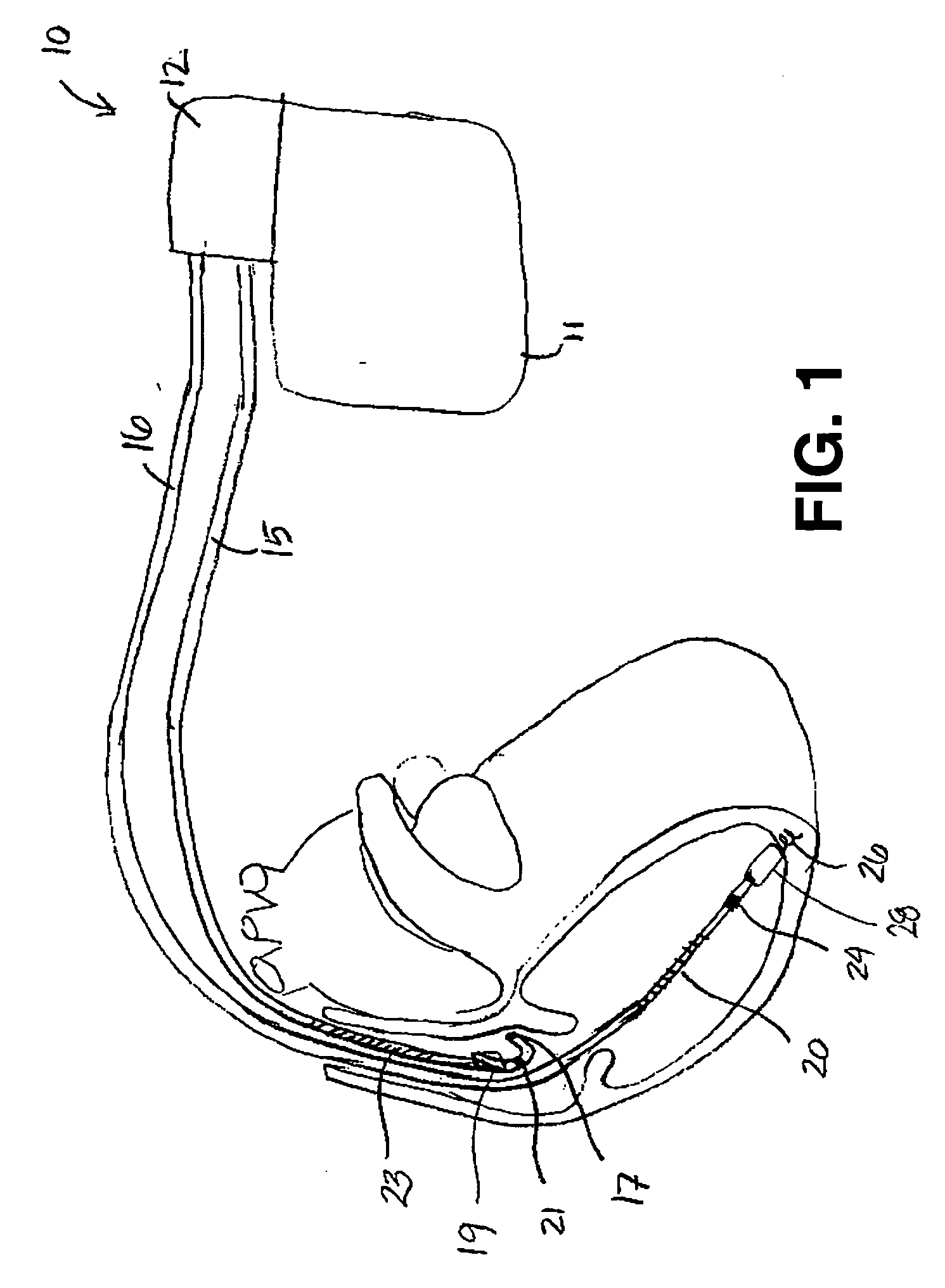 Combination of electrogram and intra-cardiac pressure to discriminate between fibrillation and tachycardia