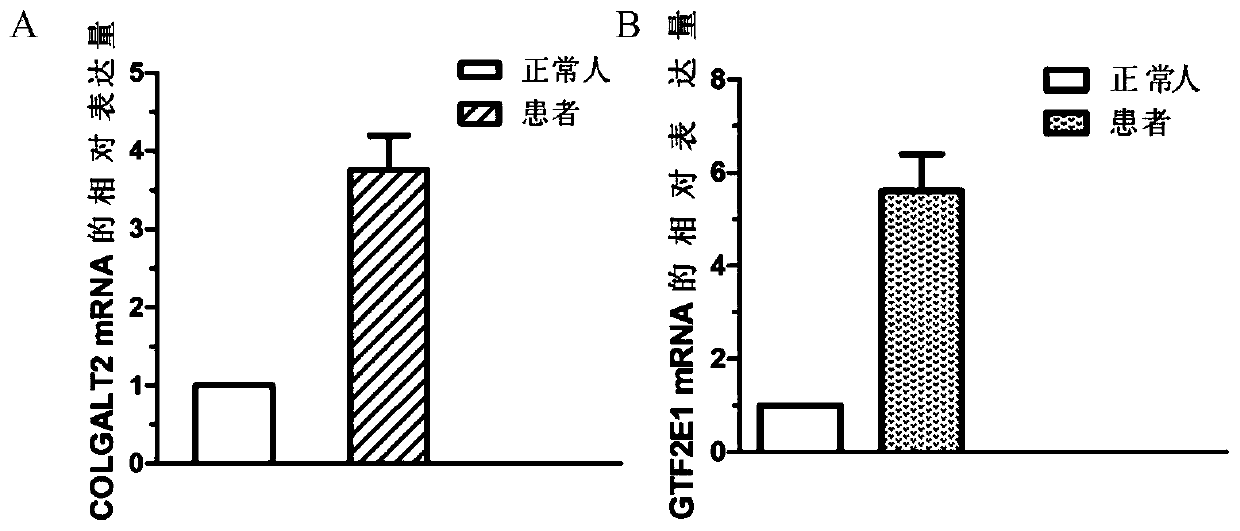 Use of genes and expression products thereof in ischemic cardiomyopathy