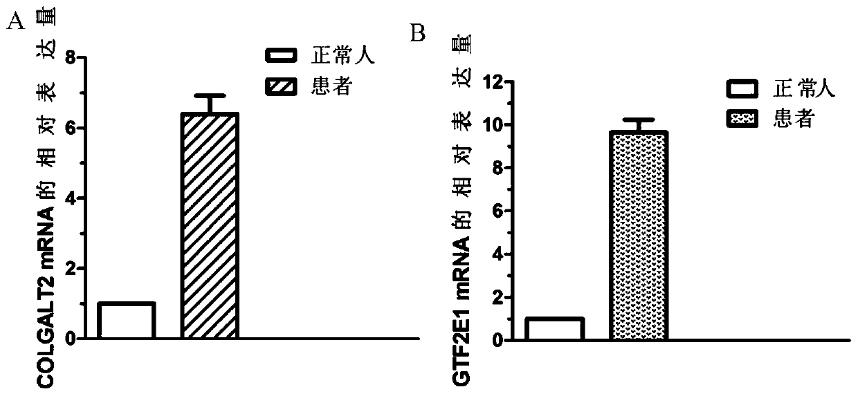 Use of genes and expression products thereof in ischemic cardiomyopathy