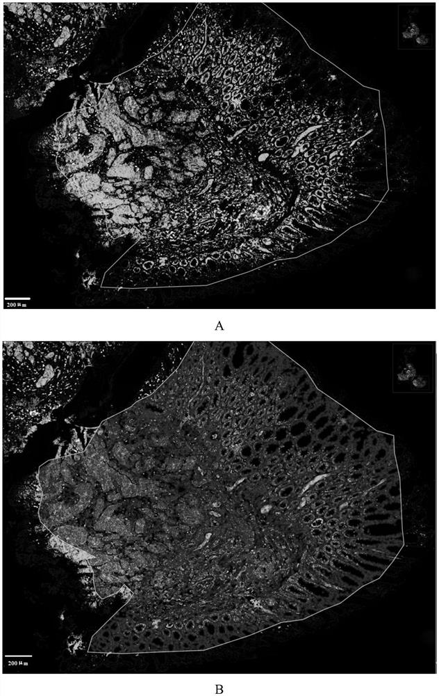 Application of reagent for detecting spatial distribution of immune checkpoints in preparation of tumor treatment and prognosis products