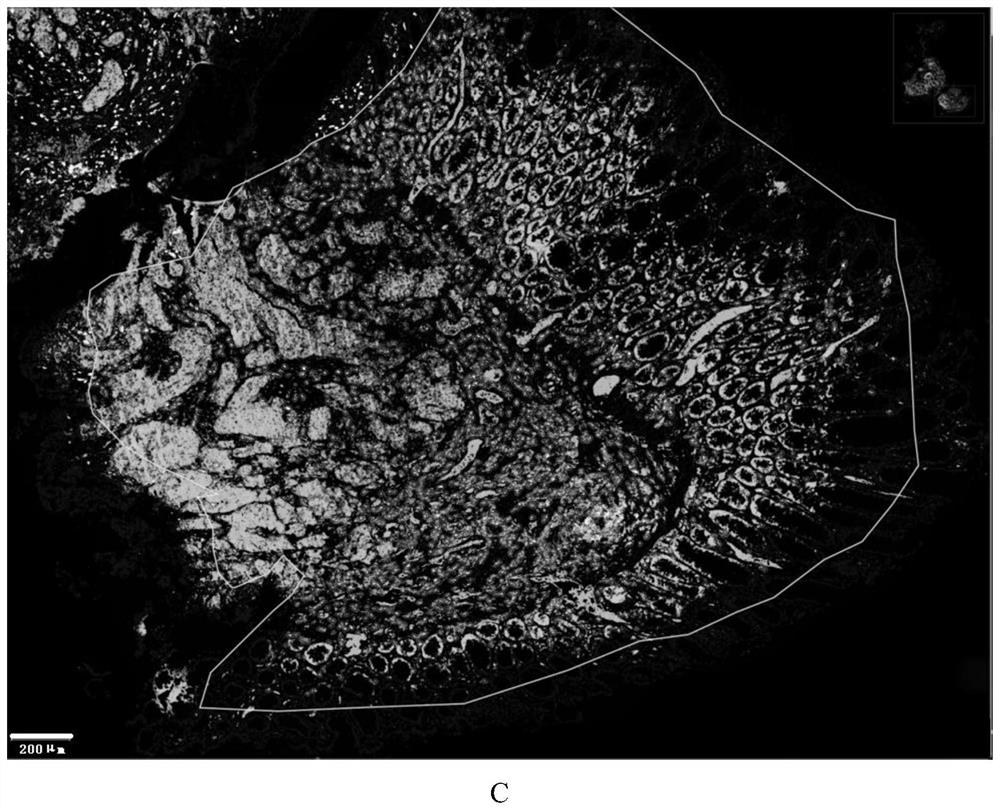 Application of reagent for detecting spatial distribution of immune checkpoints in preparation of tumor treatment and prognosis products