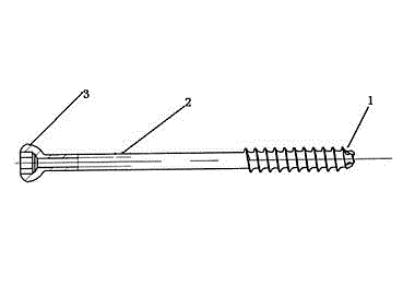 Half-thread spongy bone hollow screw