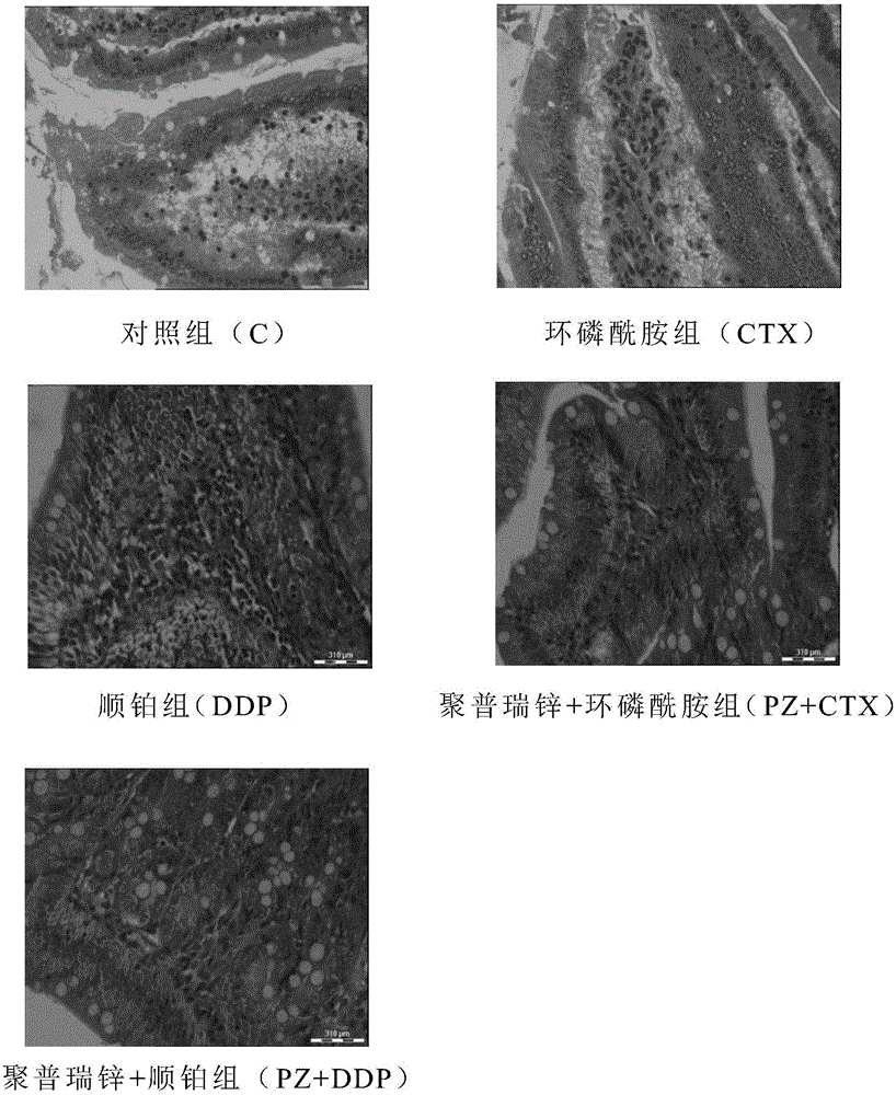 Application of polaprezinc in preparation of medicine for treating or alleviating alimentary tract complications and irritable bowel syndrome caused by chemoradiotherapy