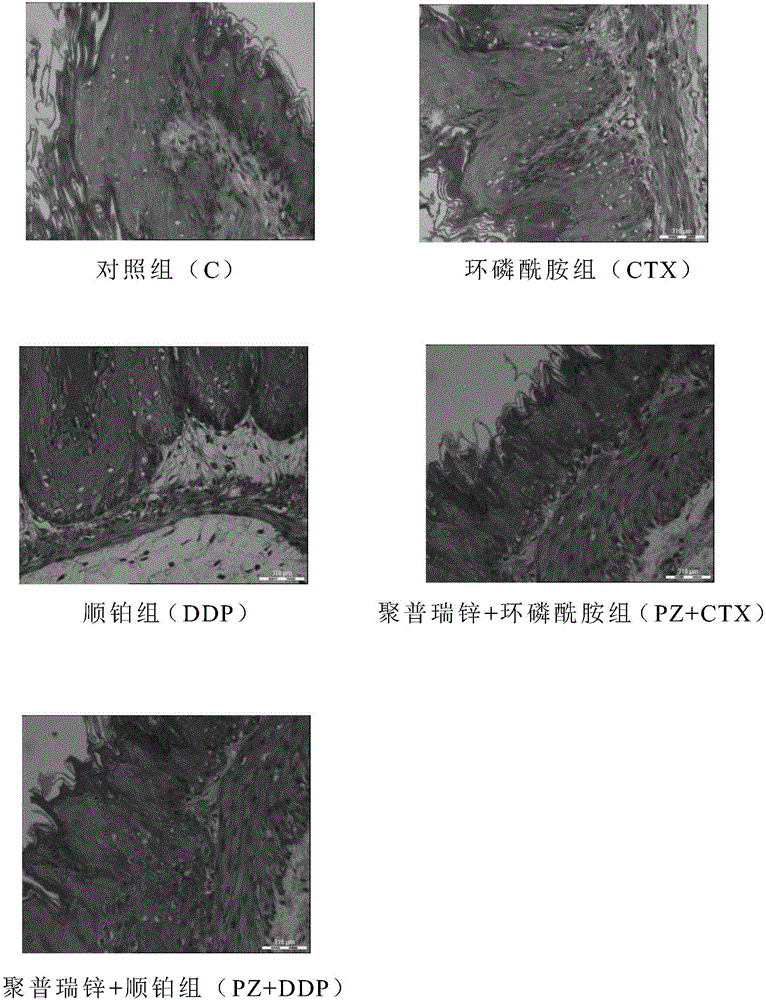 Application of polaprezinc in preparation of medicine for treating or alleviating alimentary tract complications and irritable bowel syndrome caused by chemoradiotherapy