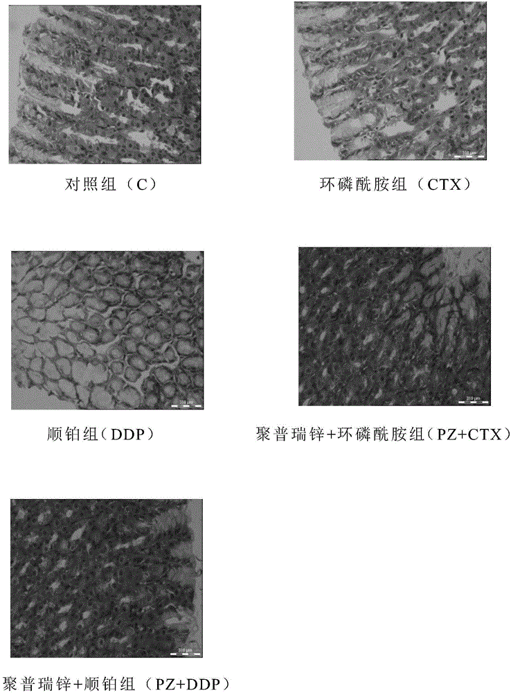 Application of polaprezinc in preparation of medicine for treating or alleviating alimentary tract complications and irritable bowel syndrome caused by chemoradiotherapy