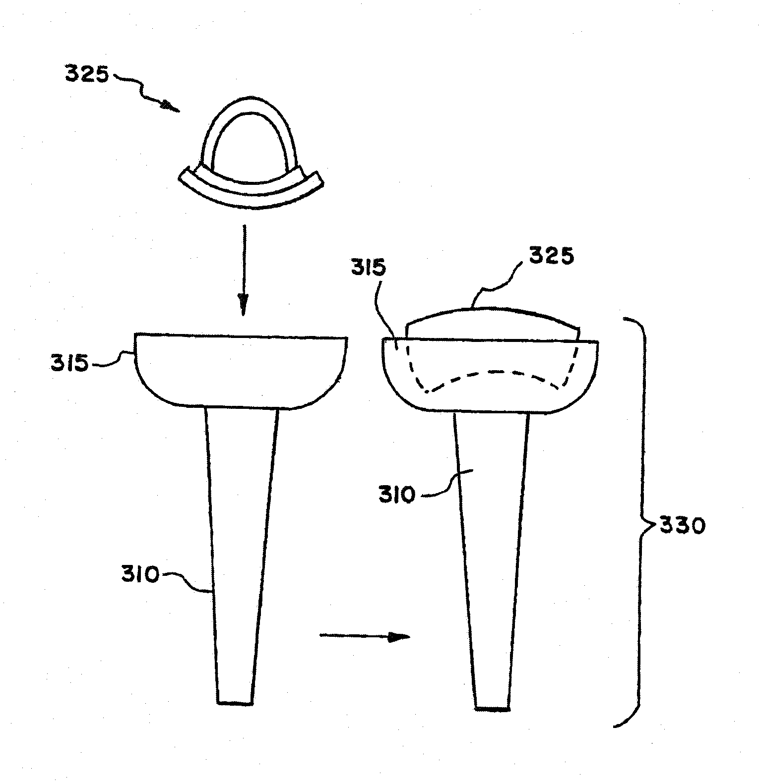 Facet arthroplasty devices and methods