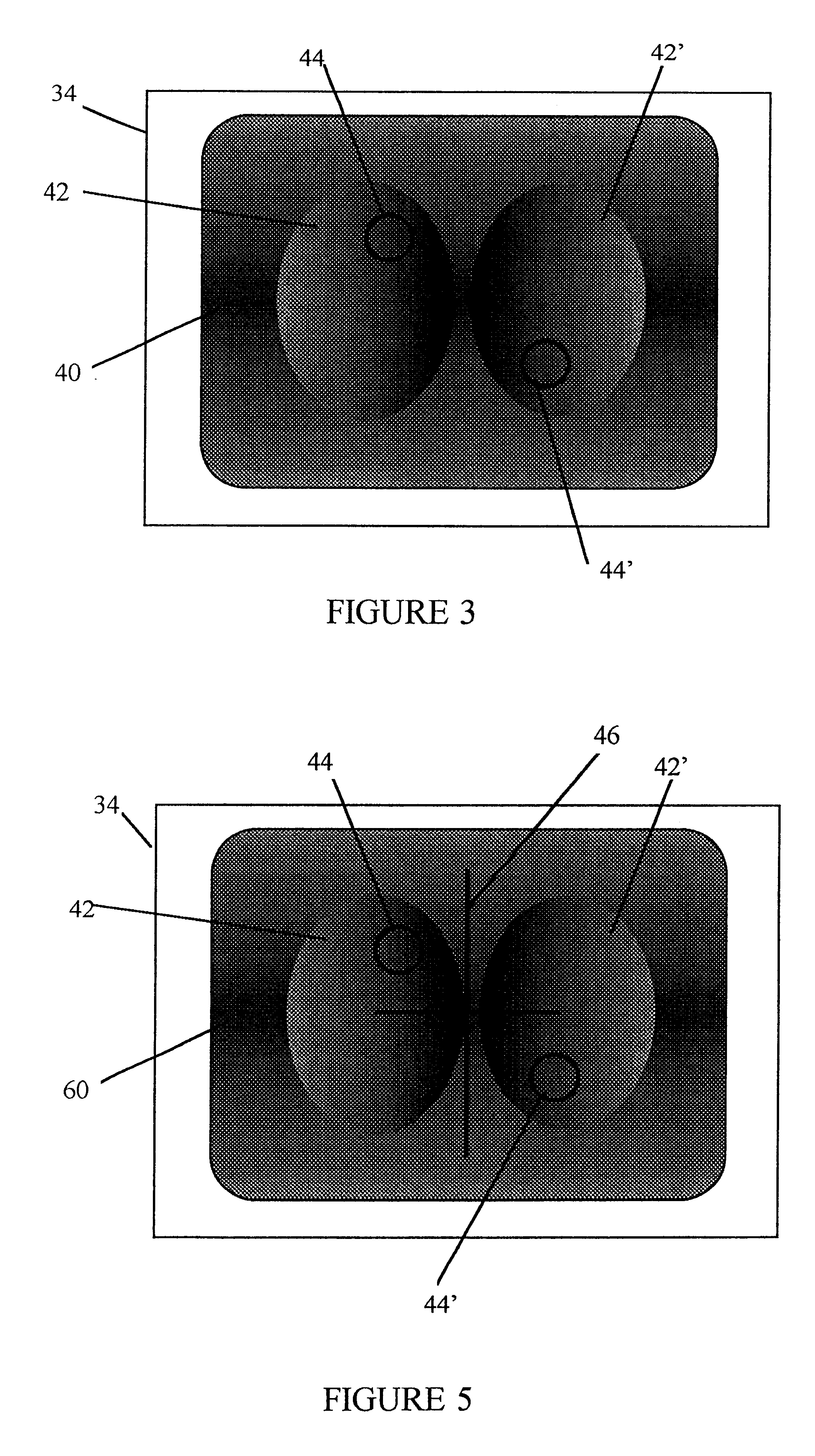 Radiogram showing location of automatic exposure control sensor