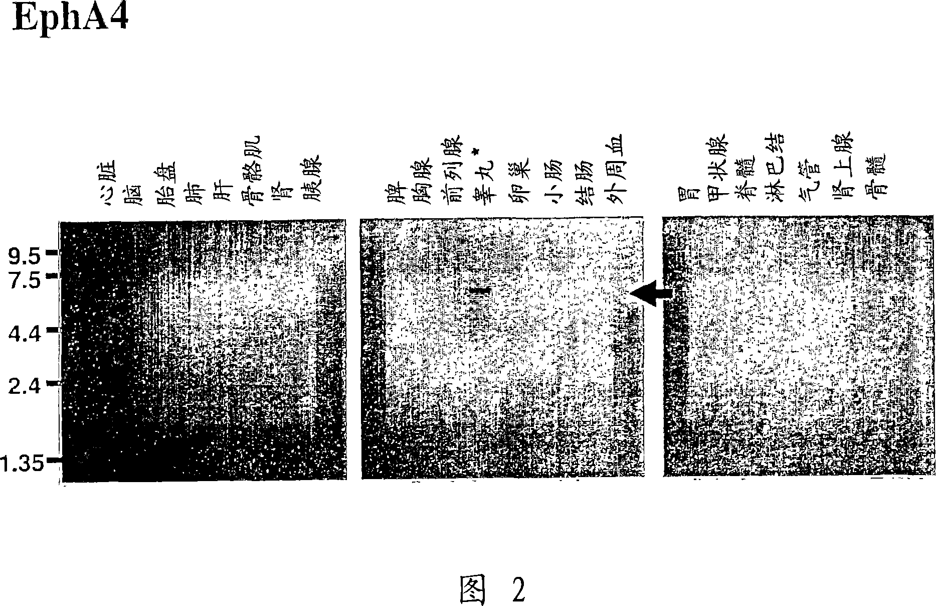 EphA4 as therapeutic target of PRC and PDACa