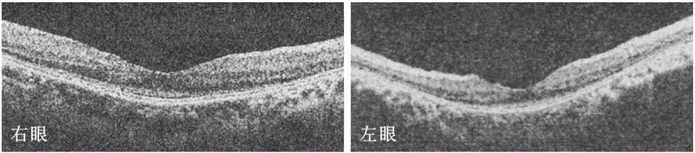 Pathogenic mutation of genetic Usher syndrome and detection reagent thereof