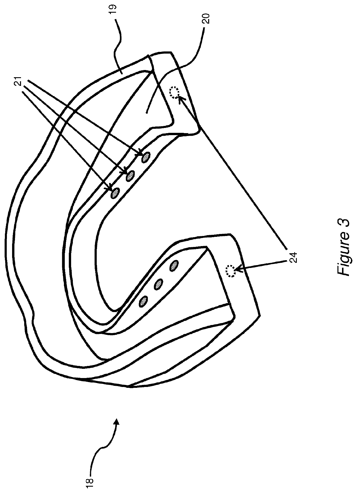 Systems, devices and methods for the treatment of oral and pharyngeal disorders