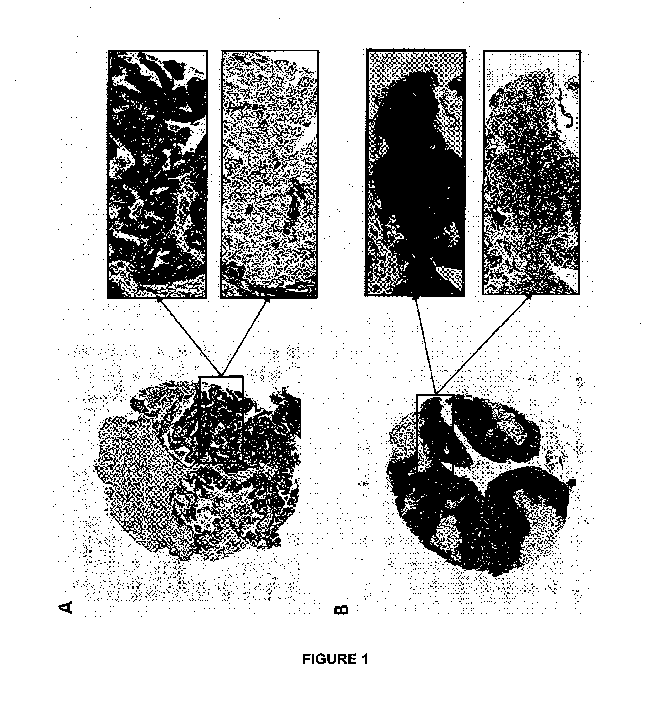 Method of Diagnosing or Prognosing Epithelial Ovarian Cancer