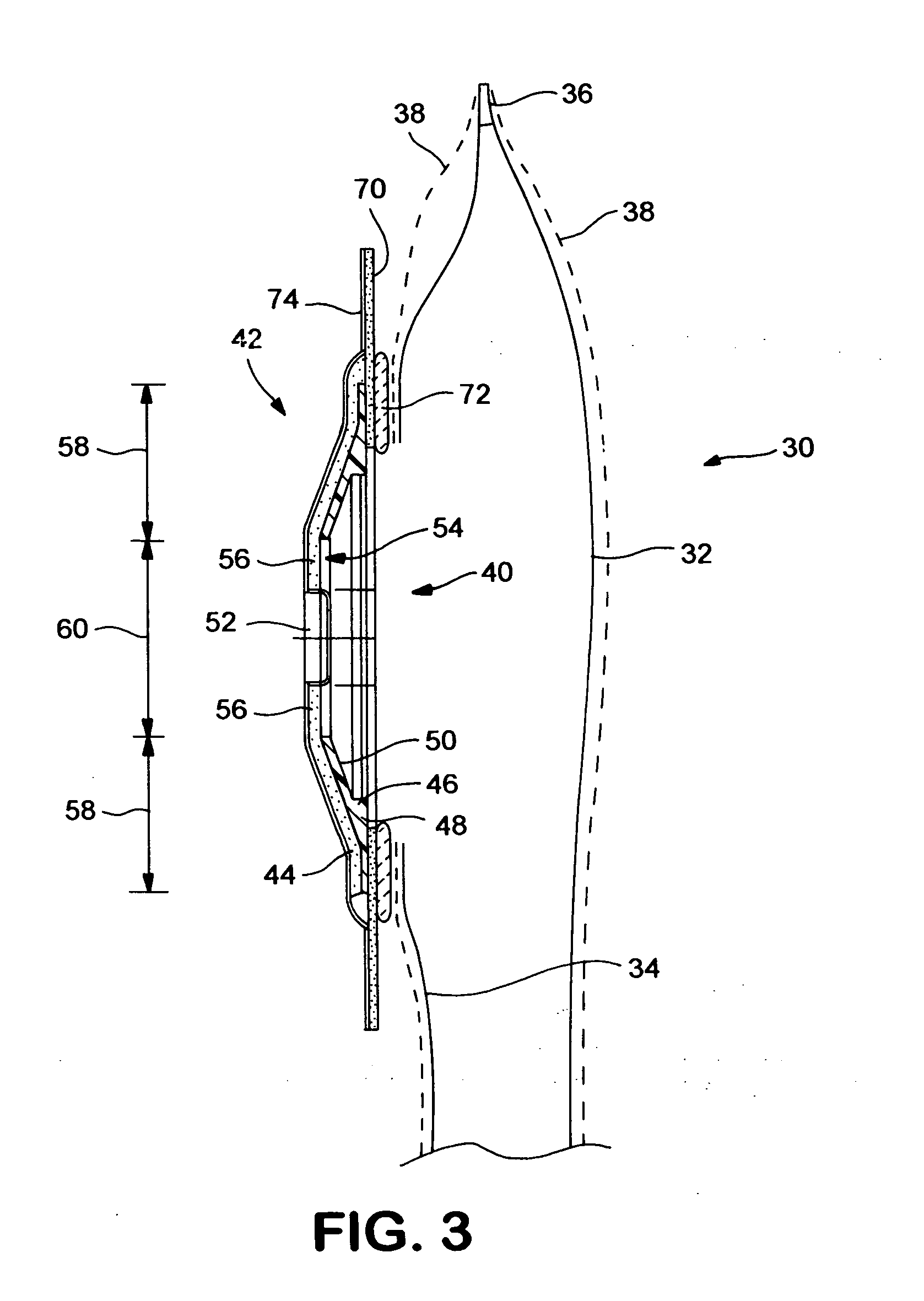 Ostomy appliance