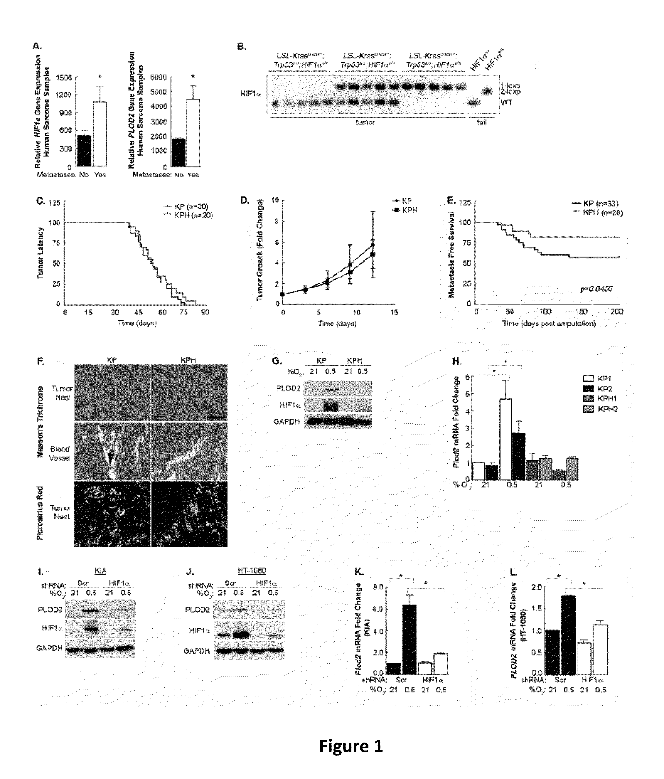 PLOD2 as a Target of Intervention for Sarcoma Metastasis