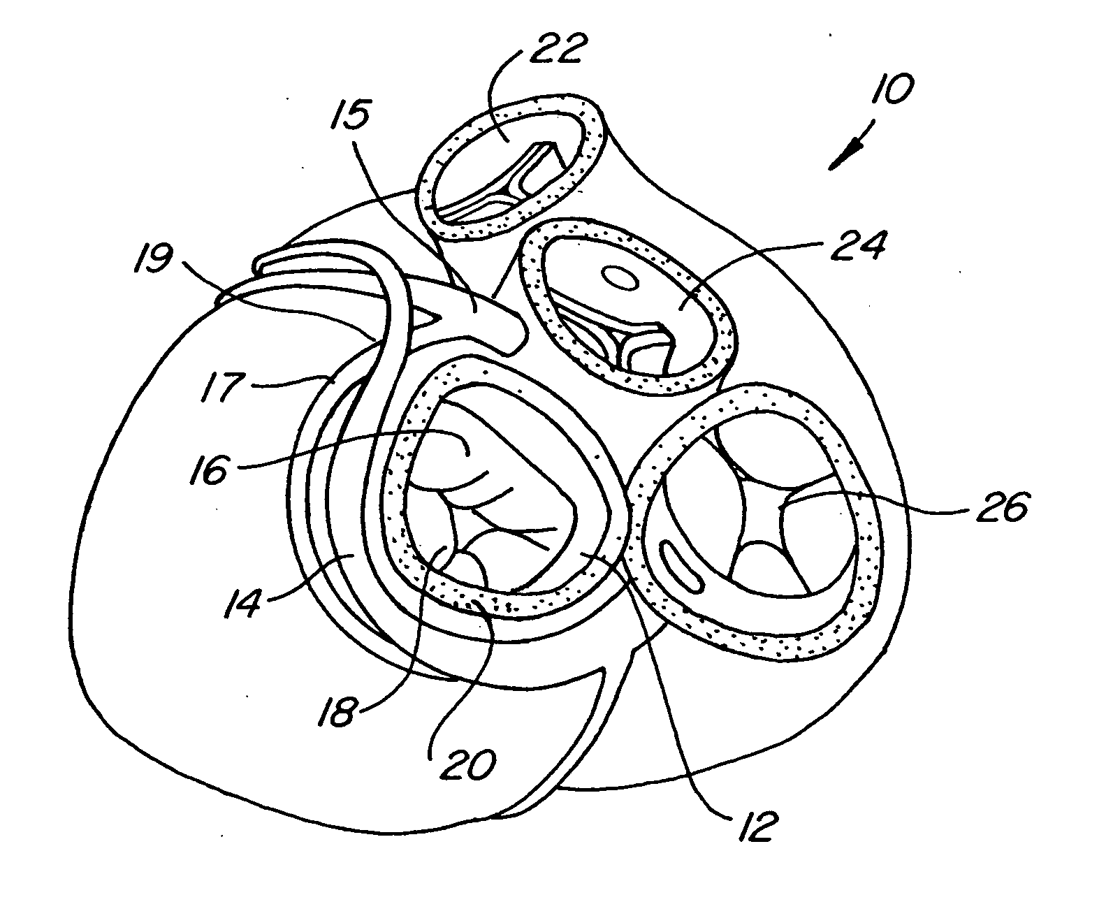 Mitral valve therapy device, system and method