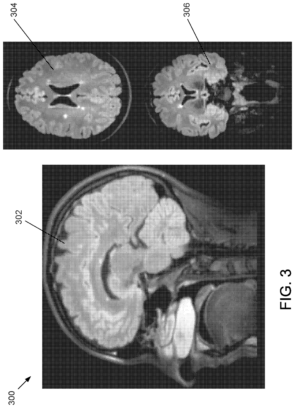 Methods, apparatuses, and systems for creating 3-dimensional representations exhibiting geometric and surface characteristics of brain lesions