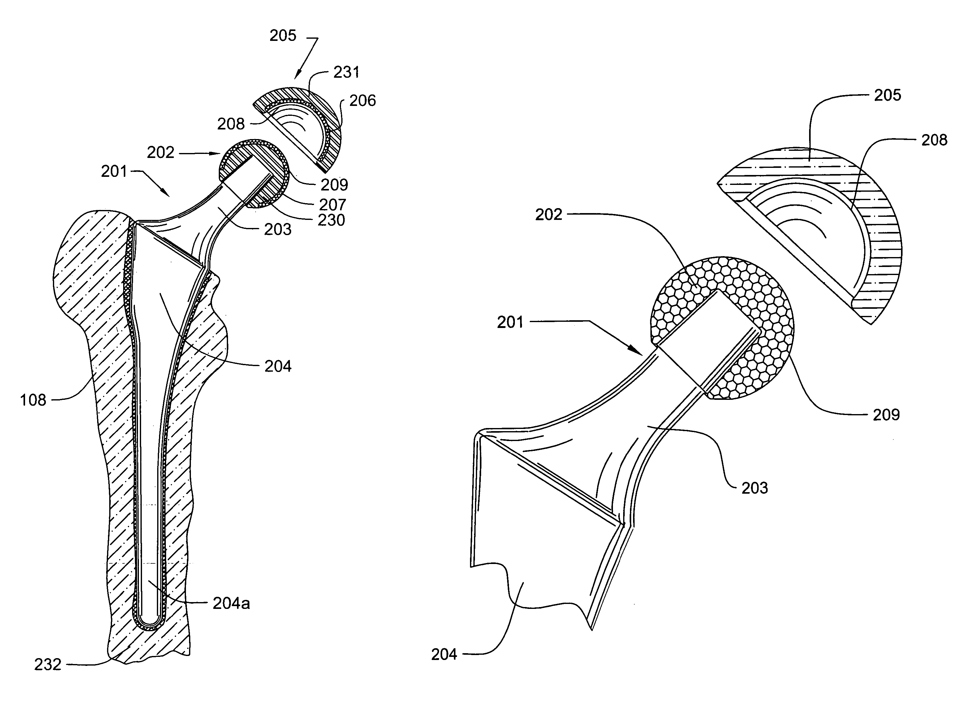 Prosthetic knee joint having at least one diamond articulation surface