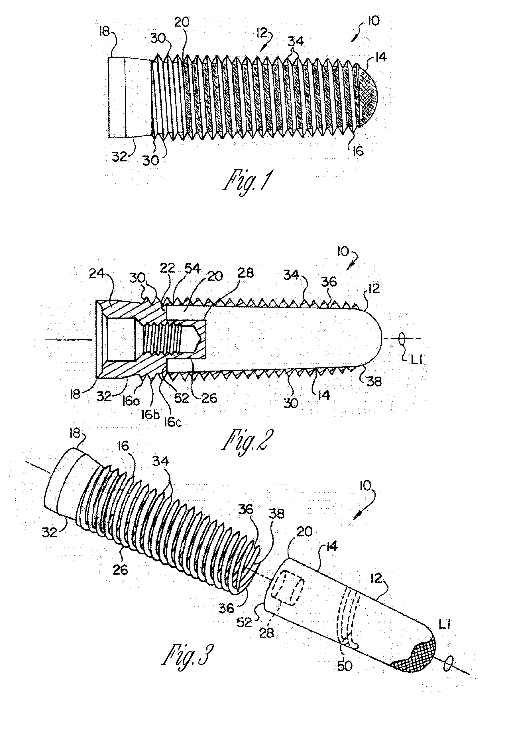 Porous implant with non-porous threads