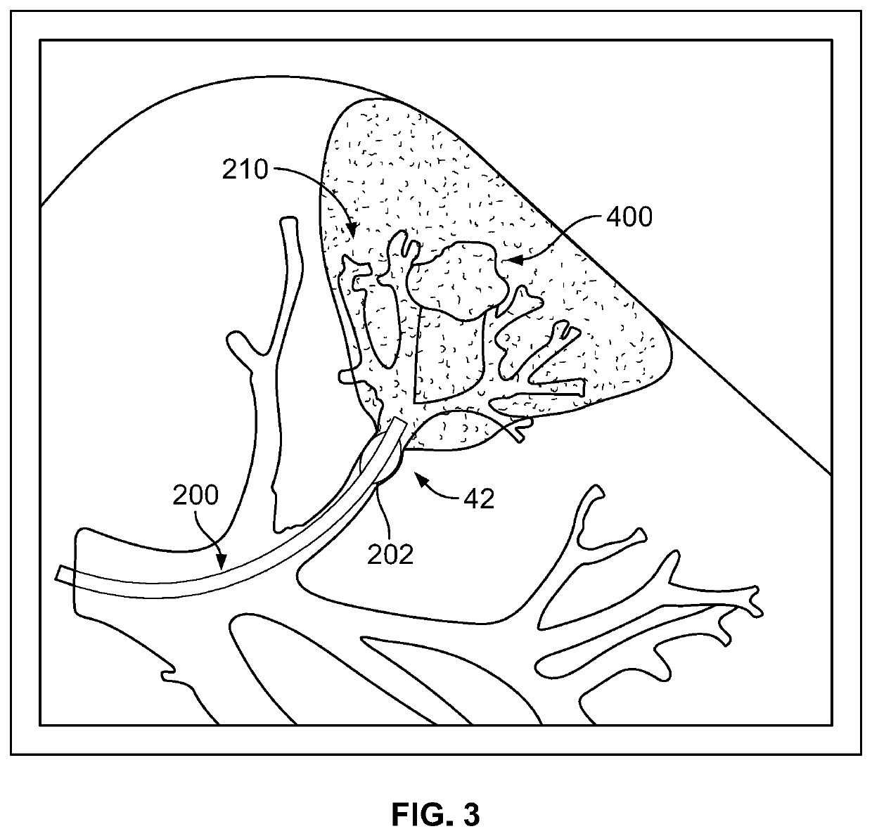 Bronchoscopic multimodality lung tumor treatment