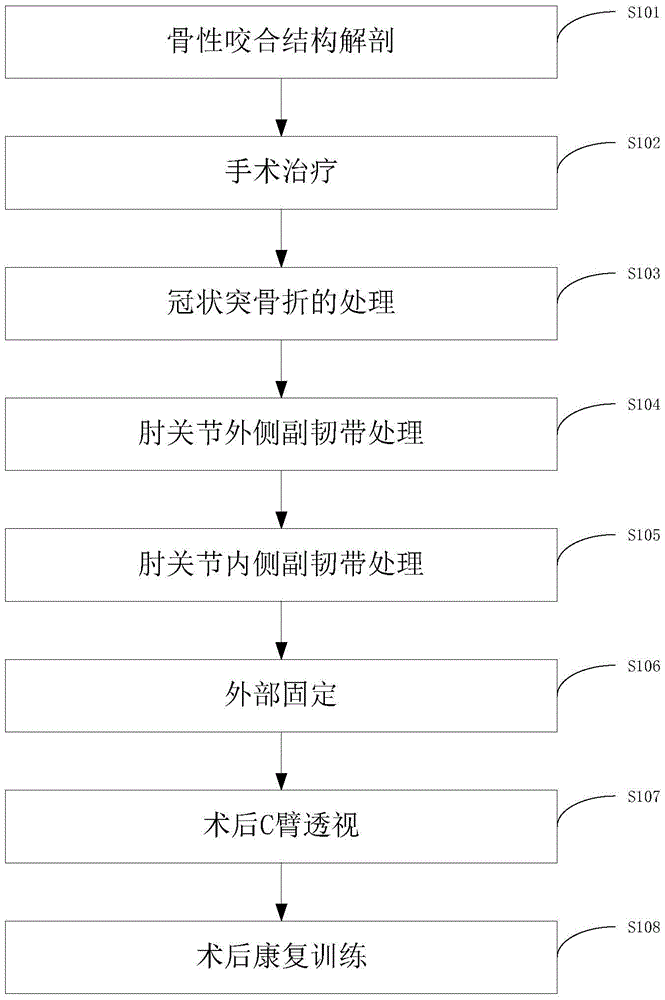 Method for adopting loop steel plate for treating ulna coracoid process fractures