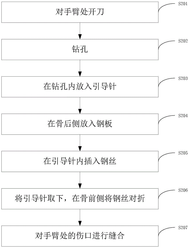 Method for adopting loop steel plate for treating ulna coracoid process fractures