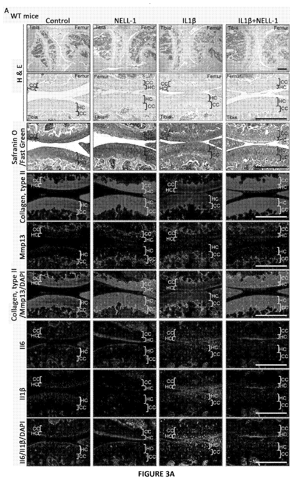 Composition and method for arthritis