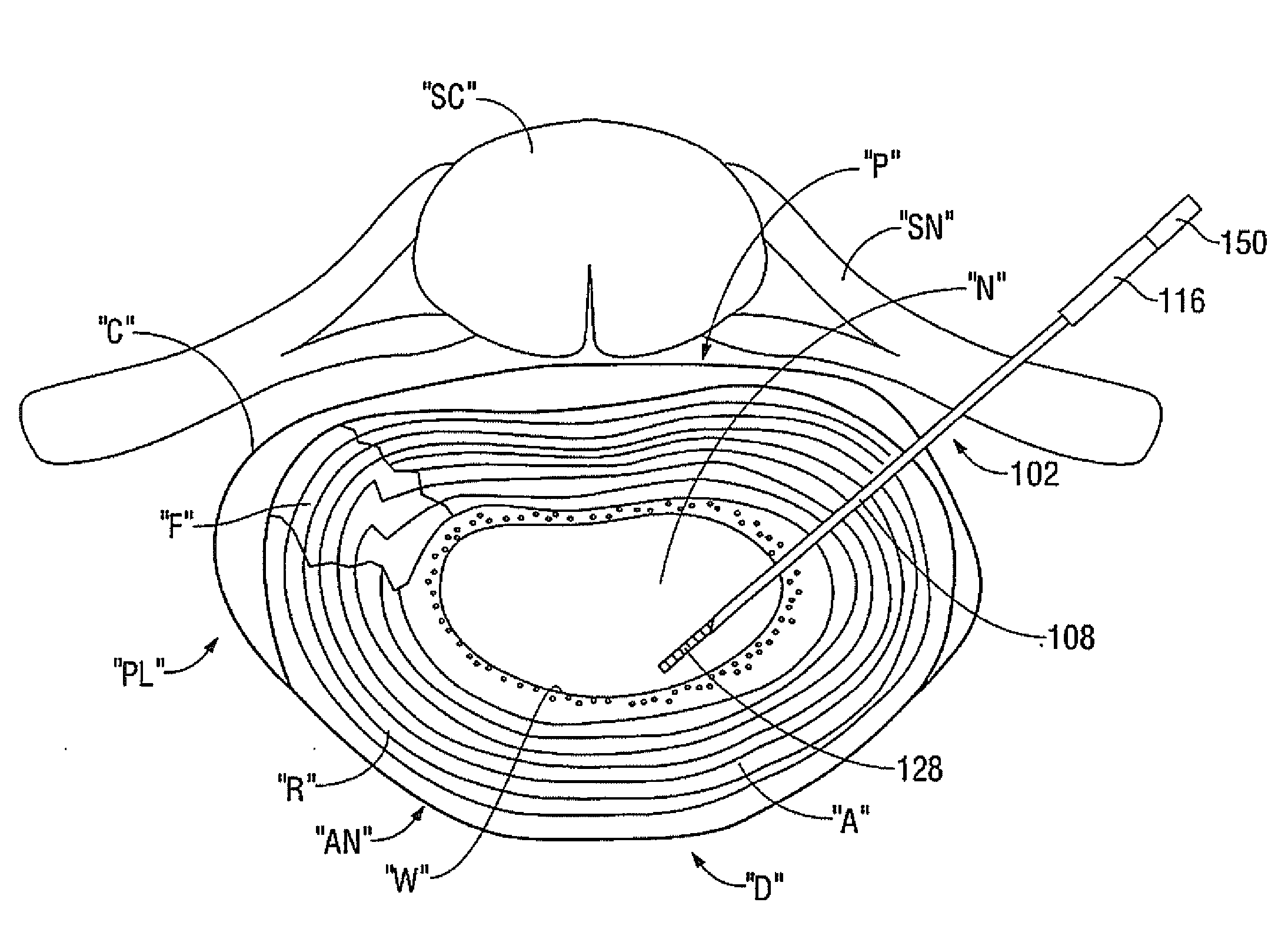 Method for Treatment of an Intervertebral Disc